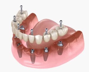 Dinti ficsi in 24 de ore – Recosntructia danturii cu implanturi dentare