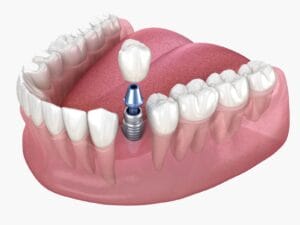 Implant dentar pret, descriere, etape