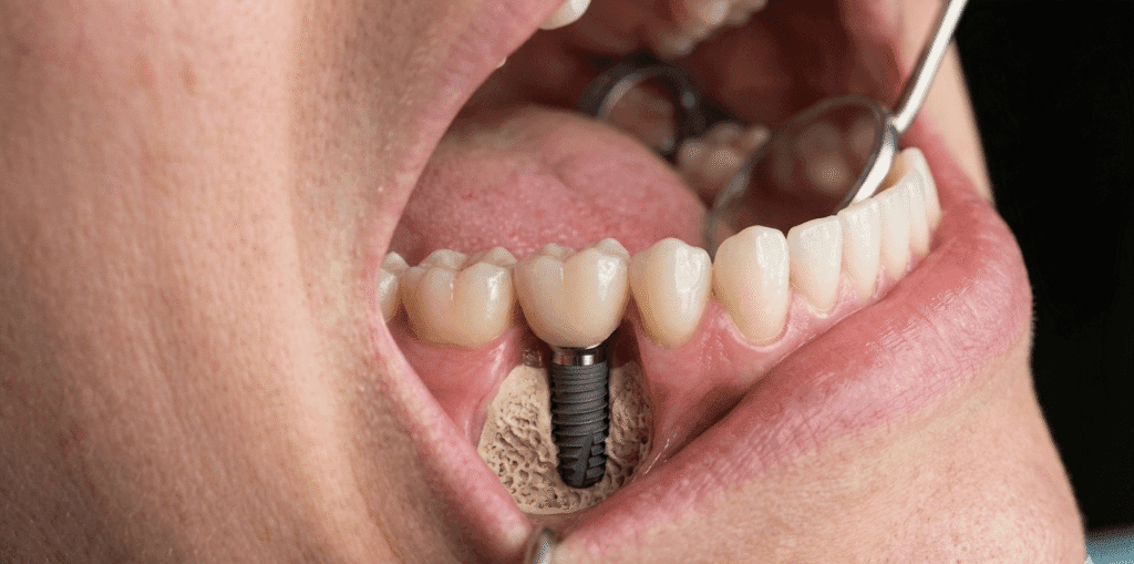 implant-dentar-bucuresti-sector1