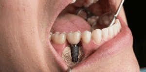 Implantul dentar – Soluția modernă și durabilă pentru înlocuirea dinților lipsă