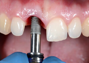Implant dentar in Bucuresti