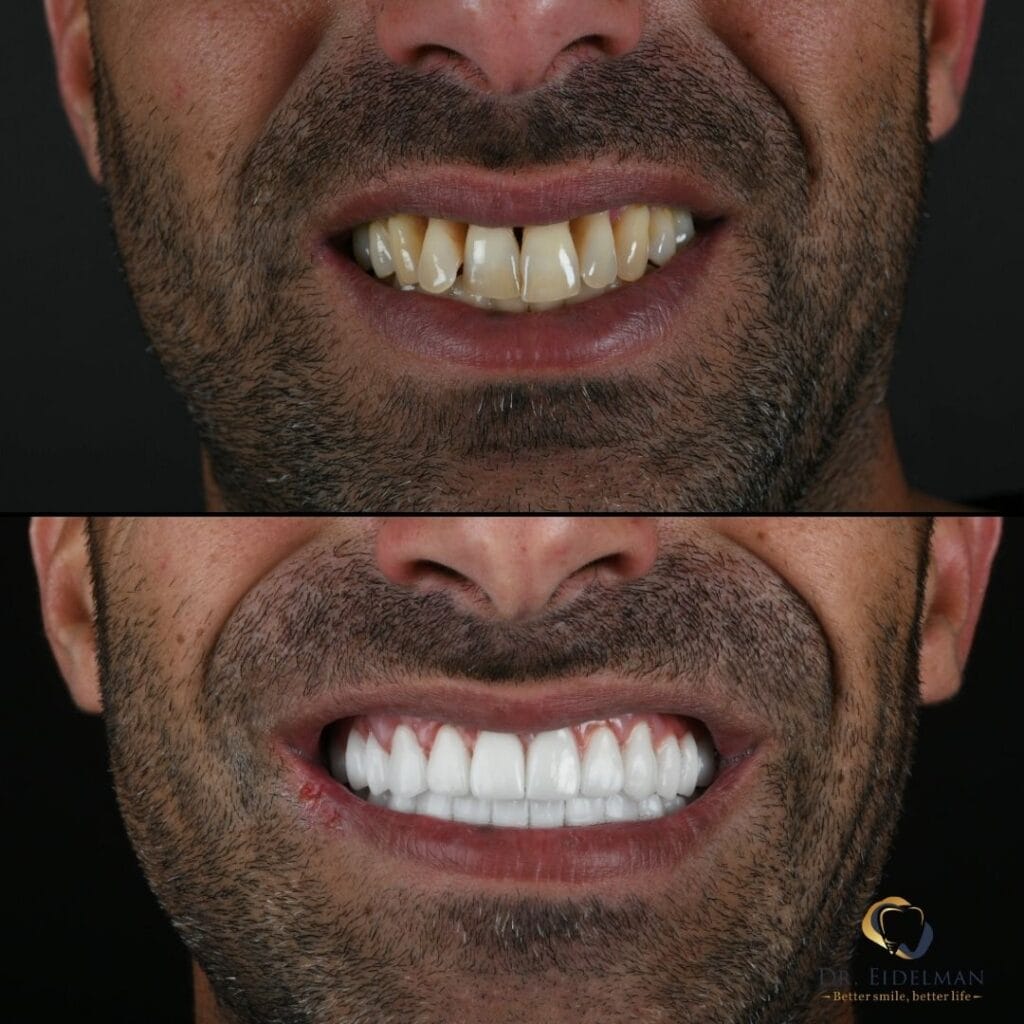 Dantura Fixa + Implant Dentar